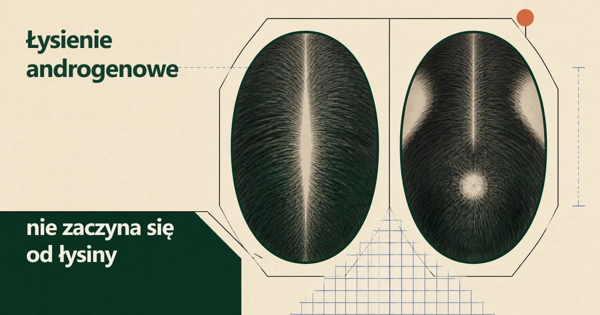 Łysienie androgenowe nie zaczyna się od łysiny