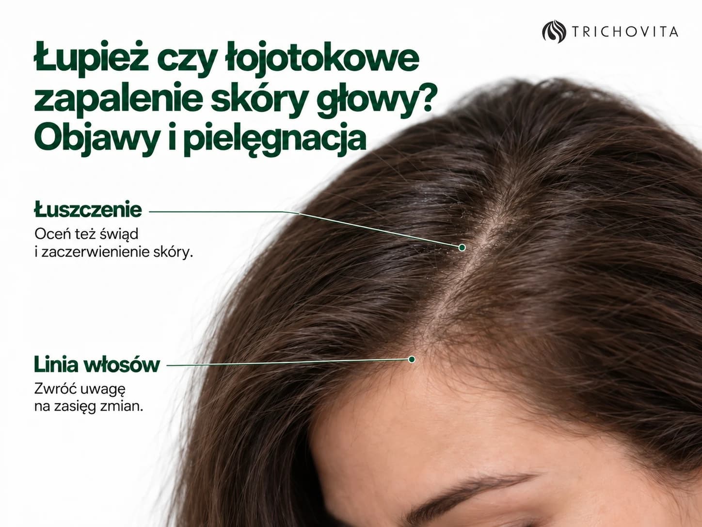 Łupież czy łojotokowe zapalenie skóry głowy? Objawy i pielęgnacja