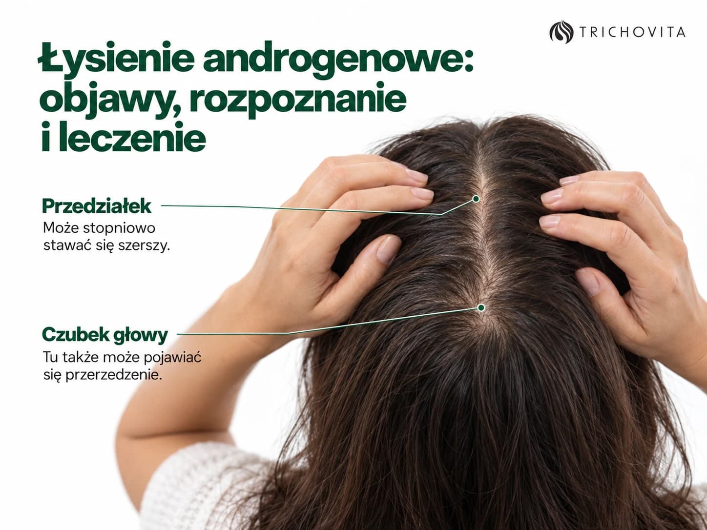 Łysienie androgenowe: objawy, rozpoznanie i leczenie