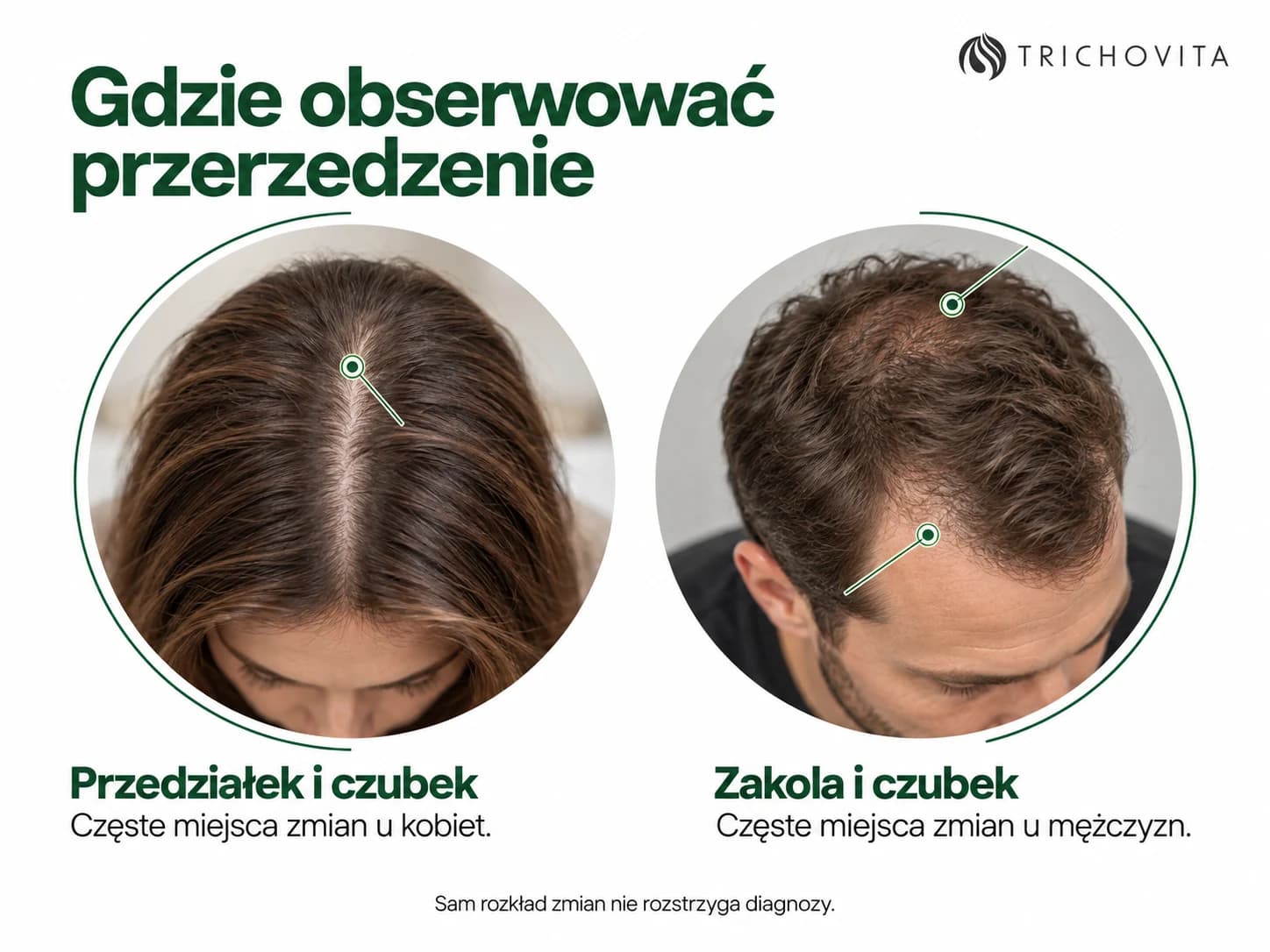 Dwa okrągłe kadry wskazujące przedziałek i czubek u kobiet oraz zakola i czubek u mężczyzn